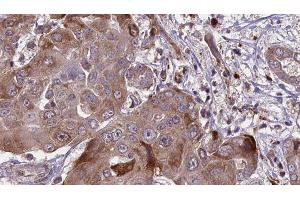ABIN6276575 at 1/100 staining Human liver cancer tissue by IHC-P. (CAPNL1 Antikörper  (N-Term))