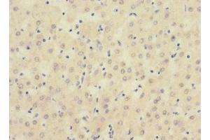 Immunohistochemistry of paraffin-embedded human liver cancer using ABIN7169723 at dilution of 1:100 (SIGIRR Antikörper  (AA 1-120))