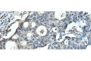 Immunohistochemistry of paraffin-embedded Human colorectal cancer tissue using FCRLA Polyclonal Antibody at dilution of 1:90(x200) (FCRLA Antikörper)
