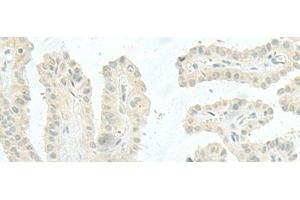 Immunohistochemistry of paraffin-embedded Human thyroid cancer tissue using MIEN1 Polyclonal Antibody at dilution of 1:45(x200) (C17orf37 Antikörper)
