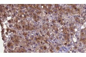 ABIN6276969 at 1/100 staining Human liver cancer tissue by IHC-P. (GRIK2 Antikörper  (Internal Region))