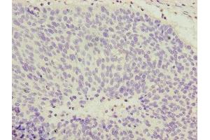 Immunohistochemistry of paraffin-embedded human cervical cancer using ABIN7148022 at dilution of 1:100 (COPZ1 Antikörper  (AA 1-177))