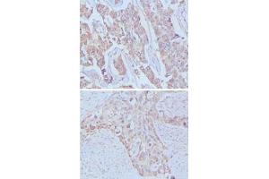 Immunohistochemical analysis of paraffin-embedded human breast cancer (upper) and lung cancer (bottom) tissues using EGF monoclonal antibody, clone 9D7F11  . (EGF Antikörper)
