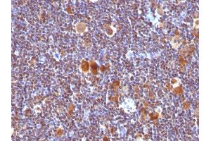 Formalin-fixed, paraffin-embedded human Hodgkin's Lymphoma stained with Bax Monoclonal Antibody (Clone SPM33).