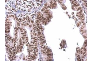 IHC-P Image COBRA1 antibody detects COBRA1 protein at nucleus on human gastric cancer by immunohistochemical analysis. (COBRA1 Antikörper  (Center))