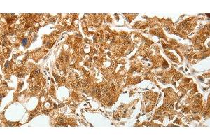 Immunohistochemistry of paraffin-embedded Human lung cancer tissue using TGF β Receptor I Polyclonal Antibody at dilution 1:60 (TGFBR1 Antikörper)