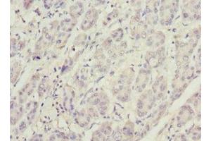 Immunohistochemistry of paraffin-embedded human liver cancer using ABIN7163403 at dilution of 1:100
