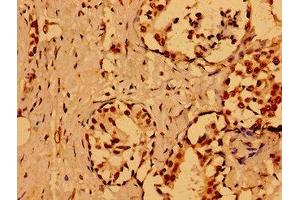 Immunohistochemistry of paraffin-embedded human breast cancer using ABIN7161807 at dilution of 1:100 (NUMA1 Antikörper  (AA 627-870))