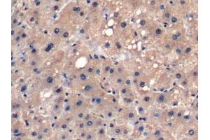 Detection of FGF21 in Human Liver cancer Tissue using Monoclonal Antibody to Fibroblast Growth Factor 21 (FGF21) (FGF21 Antikörper  (AA 29-209))