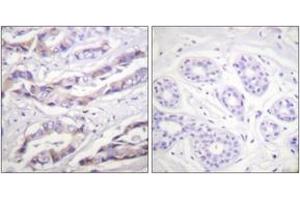 Immunohistochemistry analysis of paraffin-embedded human breast carcinoma, using p70 S6 Kinase (Phospho-Thr389) Antibody. (RPS6KB1 Antikörper  (pThr412))