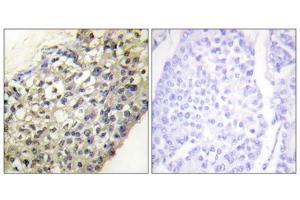Immunohistochemistry analysis of paraffin-embedded human breast carcinoma tissue, using LATH antibody. (LATH Antikörper  (Internal Region))