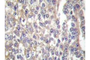 Immunohistochemistry  analyzes of Shc antibody in paraffin-embedded human breast carcinoma tissue. (SHC1 Antikörper)