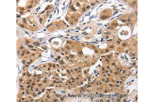 Immunohistochemistry of Human lung cancer using YWHAE Polyclonal Antibody at dilution of 1:100 (YWHAE Antikörper)
