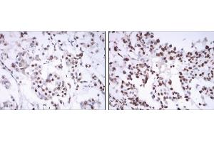 Immunohistochemical analysis of paraffin-embedded mammary cancer tissues using ESR1 mouse mAb with DAB staining. (Estrogen Receptor alpha Antikörper)