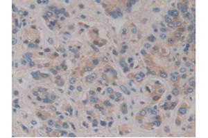 IHC-P analysis of Human Prostate Gland Cancer Tissue, with DAB staining. (HPR Antikörper  (AA 70-332))
