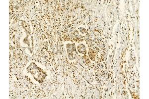 ABIN6256069 and ABIN6267241 at 1/100 staining Human normal tissues adjacent to liver cancer by IHC-P. (JAK2 Antikörper  (pTyr931))