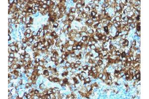 Formalin-fixed, paraffin-embedded human Melanoma stained with gp100 Rabbit Polyclonal Antibody. (Melanoma gp100 Antikörper)