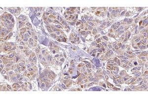 ABIN6278488 at 1/100 staining Human Melanoma tissue by IHC-P. (CCL3 Antikörper  (Internal Region))