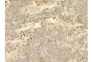 ABIN6258772 and ABIN6274897 at 1/100 staining human melanoma by IHC-P. (EPB41L2 Antikörper  (Internal Region))