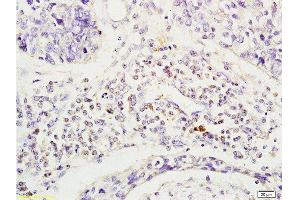 Formalin-fixed and human esophageal cancer tissue labeled with Anti-Phospho-CD19(Tyr531) Polyclonal Antibody, Unconjugated  at 1:200 followed by conjugation to the secondary antibody and DAB staining