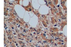 Detection of SERT in Human Breast cancer Tissue using Polyclonal Antibody to Serotonin Transporter (SERT) (SLC6A4 Antikörper  (AA 181-252))