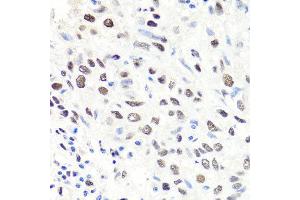 Immunohistochemistry of paraffin-embedded human lung cancer using CBX1 antibody at dilution of 1:100 (x40 lens). (CBX1 Antikörper)