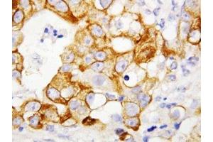 IHC-P: TNFR2 antibody testing of human breast cancer tissue (TNFRSF1B Antikörper  (Middle Region))