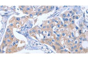 Immunohistochemistry of paraffin-embedded Human breast cancer tissue using IBSP Polyclonal Antibody at dilution of 1:50 (IBSP Antikörper)
