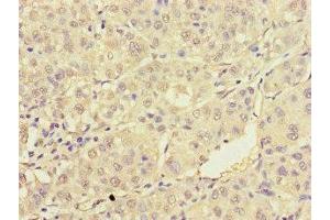 Immunohistochemistry of paraffin-embedded human liver cancer using ABIN7172232 at dilution of 1:100 (TRAF2 Antikörper  (AA 147-281))