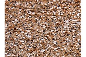 The image on the left is immunohistochemistry of paraffin-embedded Human prostate cancer tissue using ABIN7130441(NOC2L Antibody) at dilution 1/20, on the right is treated with fusion protein. (NOC2L Antikörper)