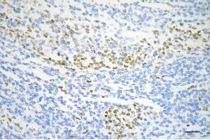 Immunohistochemistry was performed on paraffin-embedded human sigmoid colon carcinoma using MCM6 antibody (ABIN7799421), 1:200). (Rekombinanter MCM6 Antikörper)