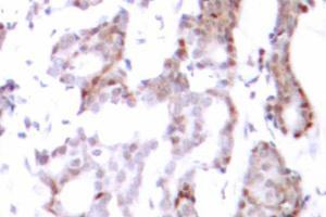 Immunohistochemistry (IHC) analysis of Elk1 antibody in paraffin-embedded human breast carcinoma tissue. (ELK1 Antikörper)