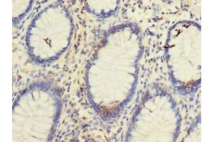 Immunohistochemistry of paraffin-embedded human colon cancer using ABIN7171842 at dilution of 1:100 (TSPAN1 Antikörper  (AA 110-211))
