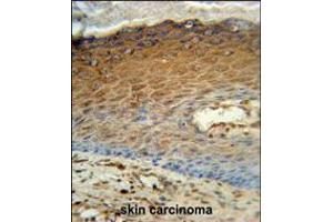 AK7 Antibody immunohistochemistry analysis in formalin fixed and paraffin embedded human skin carcinoma followed by peroxidase conjugation of the secondary antibody and DAB staining. (Adenylate Kinase 7 Antikörper  (C-Term))