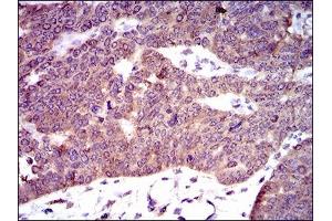 Immunohistochemical analysis of paraffin-embedded ovarian cancer tissues using PDE1B mouse mAb with DAB staining. (PDE1B Antikörper  (AA 370-536))