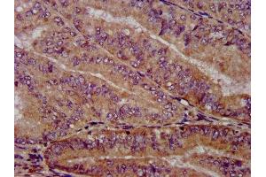 IHC image of ABIN7169262 diluted at 1:1000 and staining in paraffin-embedded human endometrial cancer performed on a Leica BondTM system. (PPP2R4 Antikörper  (AA 1-250))