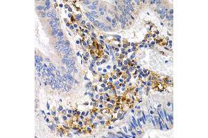 Immunohistochemistry of paraffin-embedded human colon cancer using GDF5 antibody at dilution of 1:200 (400x lens). (GDF5 Antikörper)