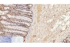 Immunohistochemistry of paraffin-embedded Human colon tissue using CD2 Monoclonal Antibody at dilution of 1:200. (CD2 Antikörper)