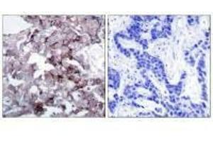 Immunohistochemistry analysis of paraffin-embedded human breast carcinoma tissue, using EGFR (Ab-1172) antibody.