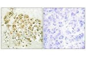 Immunohistochemistry analysis of paraffin-embedded human breast carcinoma tissue using MZF-1 antibody.