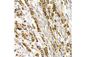 Immunohistochemistry of paraffin-embedded human stomach cancer using TACR3 antibody. (TACR3 Antikörper)