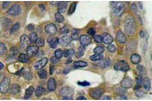 Immunohistochemistry (IHC) analyzes of p-ASK1 antibody in paraffin-embedded human breast carcinoma tissue (ASK1 Antikörper  (pSer966))