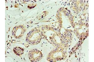 Immunohistochemistry of paraffin-embedded human breast cancer using ABIN7145038 at dilution of 1:100 (ATAD3A Antikörper  (AA 1-240))