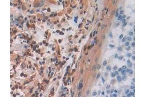 Detection of MAEA in Human Skin cancer Tissue using Polyclonal Antibody to Macrophage Erythroblast Attacher (MAEA) (MAEA Antikörper  (AA 136-379))
