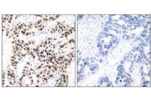 Immunohistochemical analysis of paraffin-embedded human breast carcinoma tissue using Myc (Ab-58) antibody (E021034). (c-MYC Antikörper)