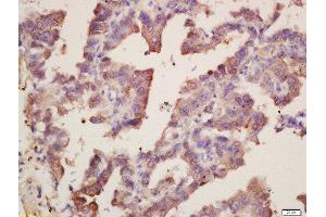 Formalin-fixed and paraffin embedded human lung carcinoma labeled with Rabbit Anti-SOD1 Polyclonal Antibody, Unconjugated  at 1:200 followed by conjugation to the secondary antibody and DAB staining (SOD1 Antikörper  (AA 6-100))