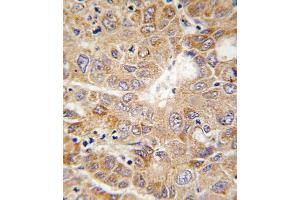 Formalin-fixed and paraffin-embedded human hepatocarcinoma tissue reacted with PGK1 antibody , which was peroxidase-conjugated to the secondary antibody, followed by DAB staining. (PGK1 Antikörper  (AA 117-145))