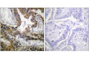 Immunohistochemistry analysis of paraffin-embedded human lung carcinoma tissue, using VEGFR2 (Ab-1054) Antibody. (VEGFR2/CD309 Antikörper  (AA 1020-1069))