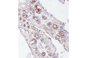 Anti-PCSK9 antibody, IHC(P) IHC(P): Human Intestinal Cancer Tissue (PCSK9 Antikörper  (C-Term))