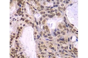 Immunohistochemistry of paraffin-embedded Human oophoroma using POLD3 Polyclonal Antibody at dilution of 1:100 (40x lens). (POLD3 Antikörper)